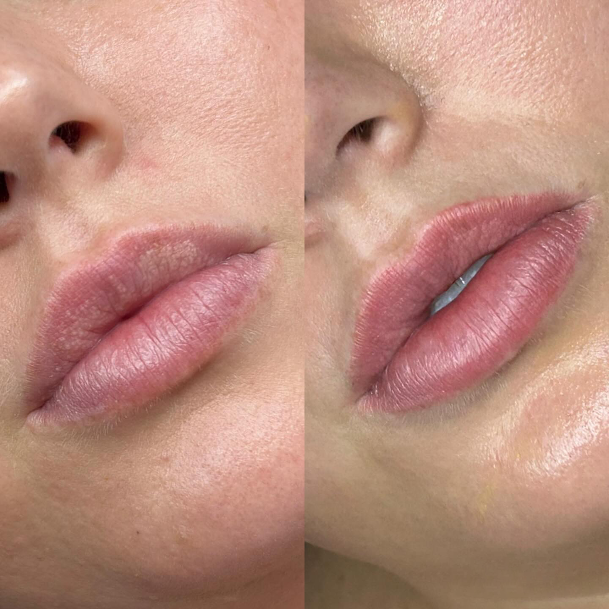 Fordyce Cream for Lips