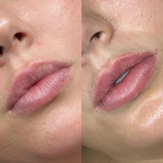 Fordyce Cream for Lips