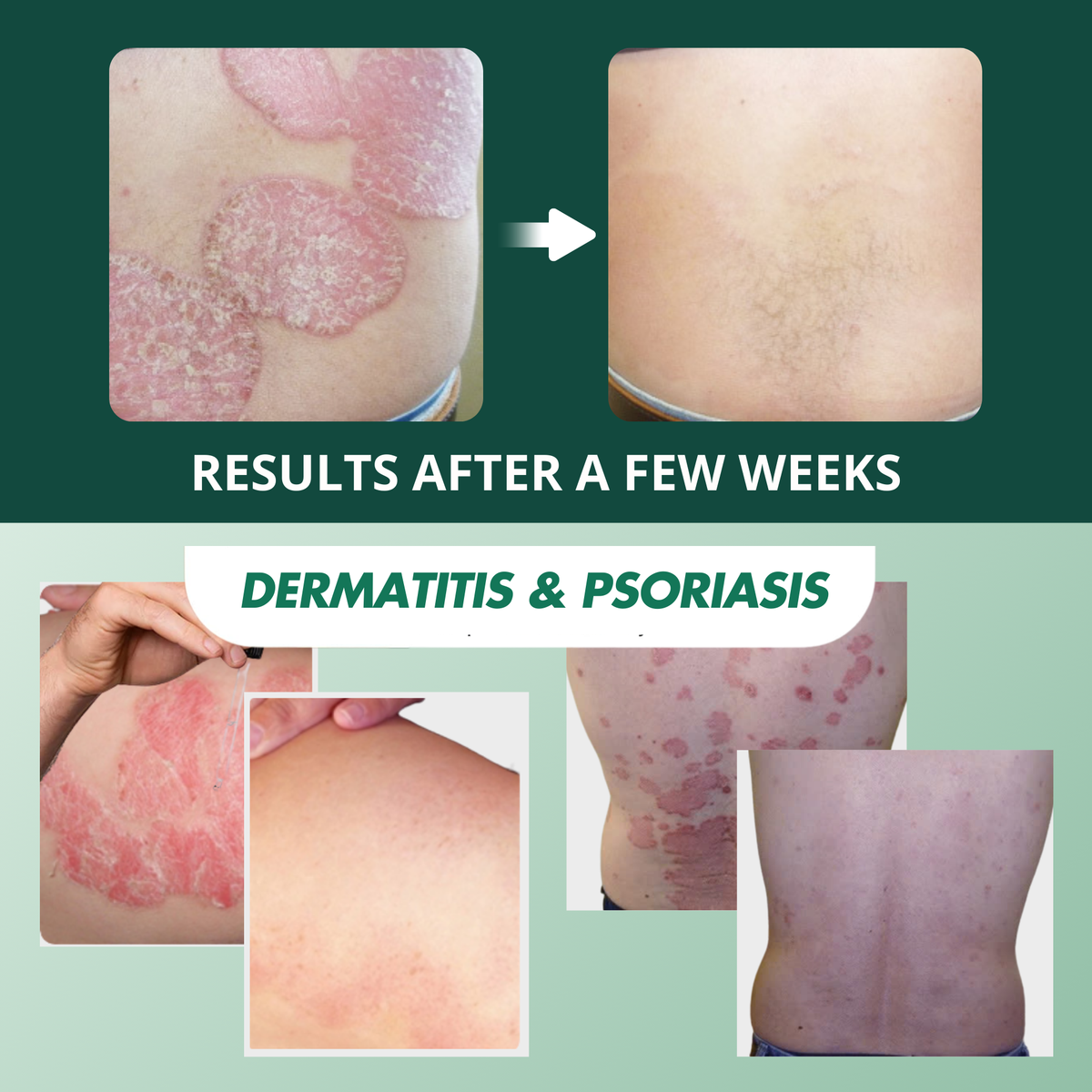 Crema Abera Fordyce - La solución #1 recomendada por dermatólogos para las manchas de Fordyce en los labios