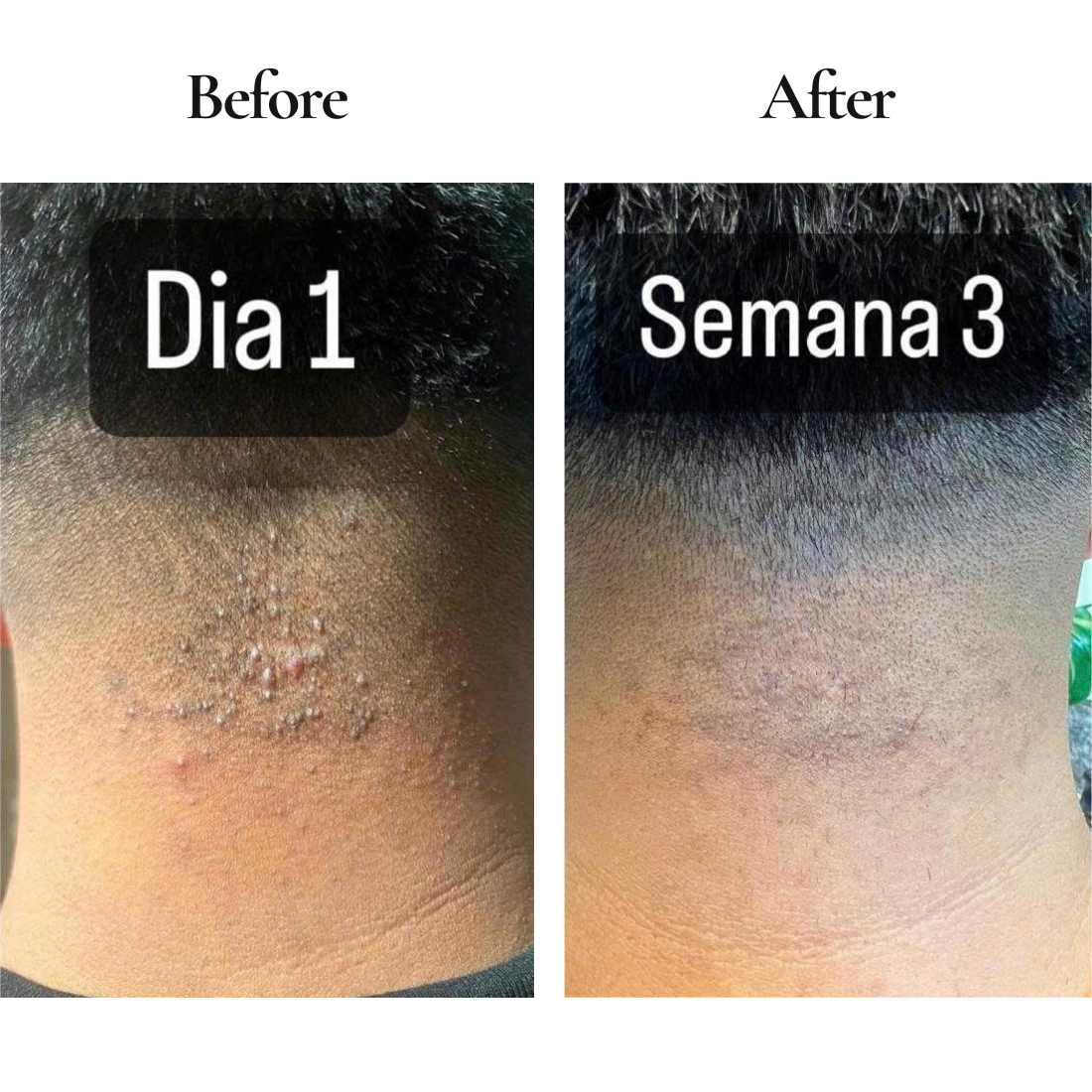 ABERA Amanda Champú Anti-Foliculitis y Dermatitis Seborreica 6.67 fl.oz - Auténtico
