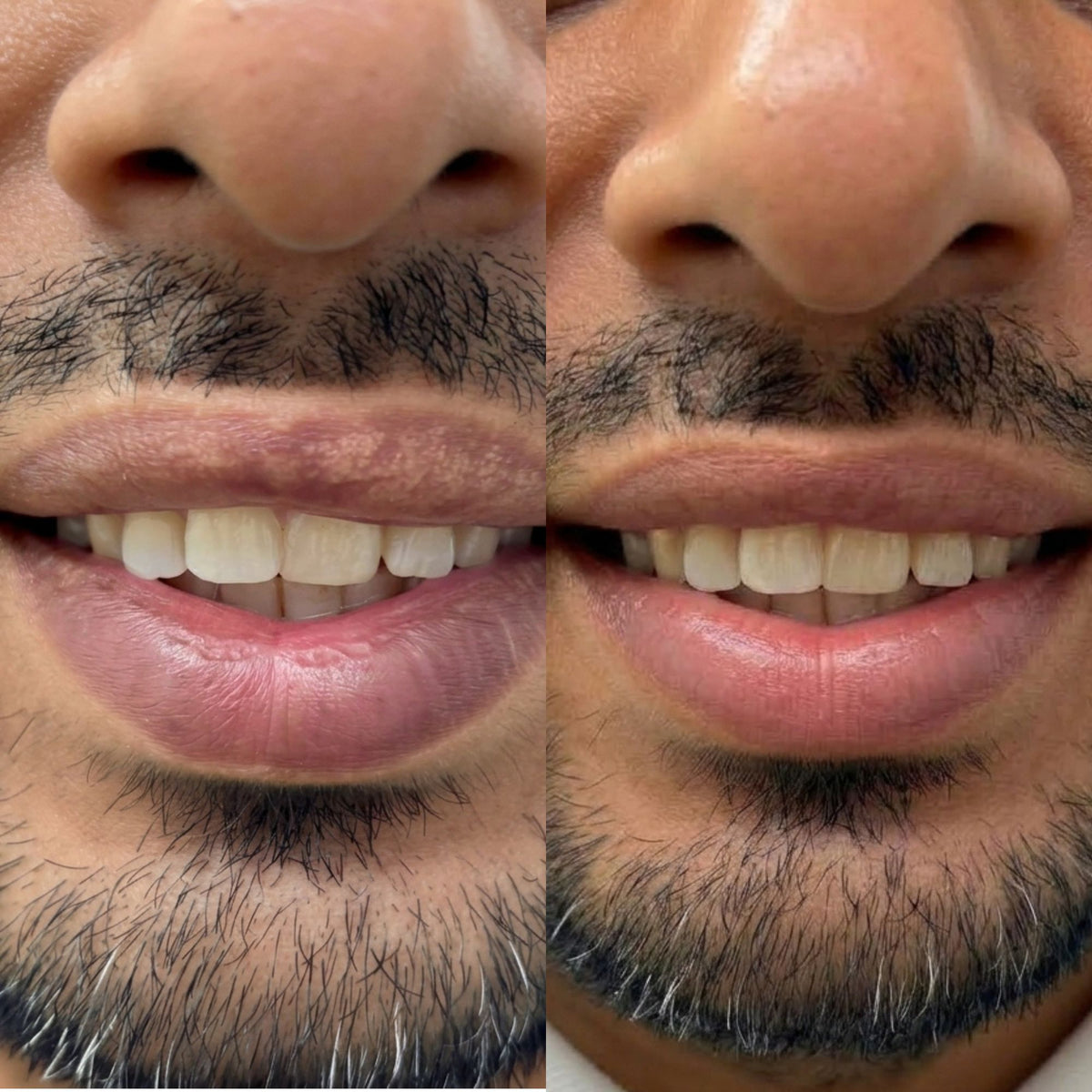 Fordyce Cream for Lips