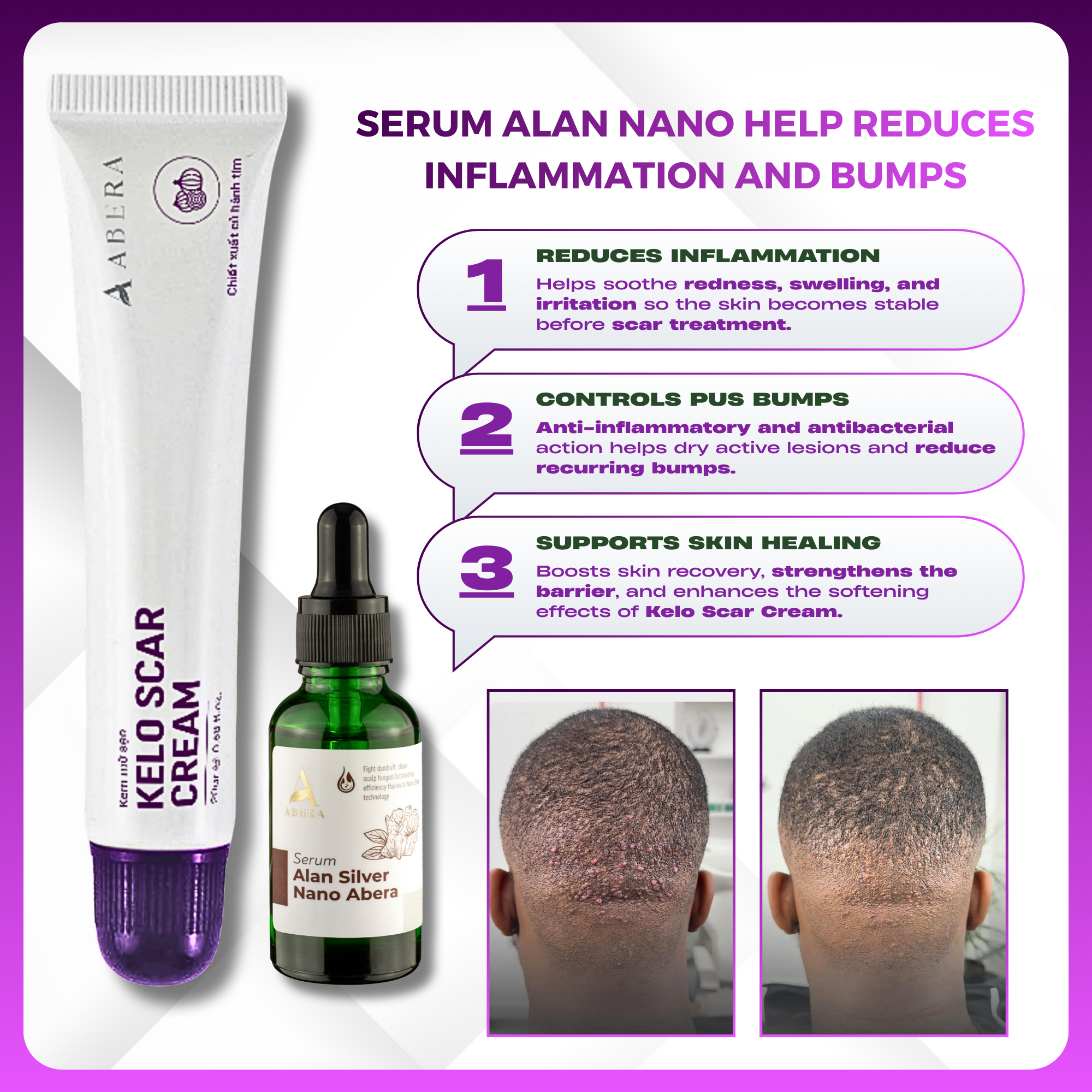 [Auténtico] Crema para cicatrices Abera Kelo - Tratamiento de acné queloide nucal (AKN) y protuberancias de afeitado - 0.67oz (20g)