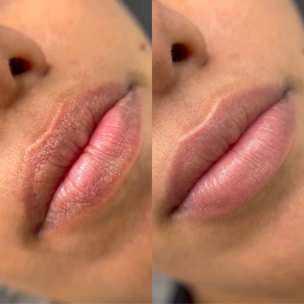 Fordyce Cream for Lips