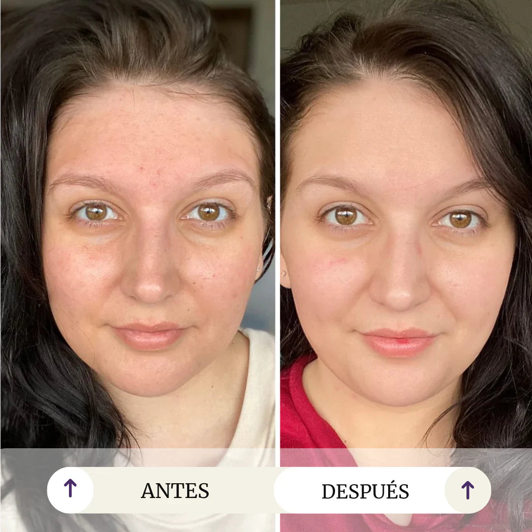 Intensive Melasma Care Duo – Targets Dark Spots, Freckles and Long-Term Discoloration