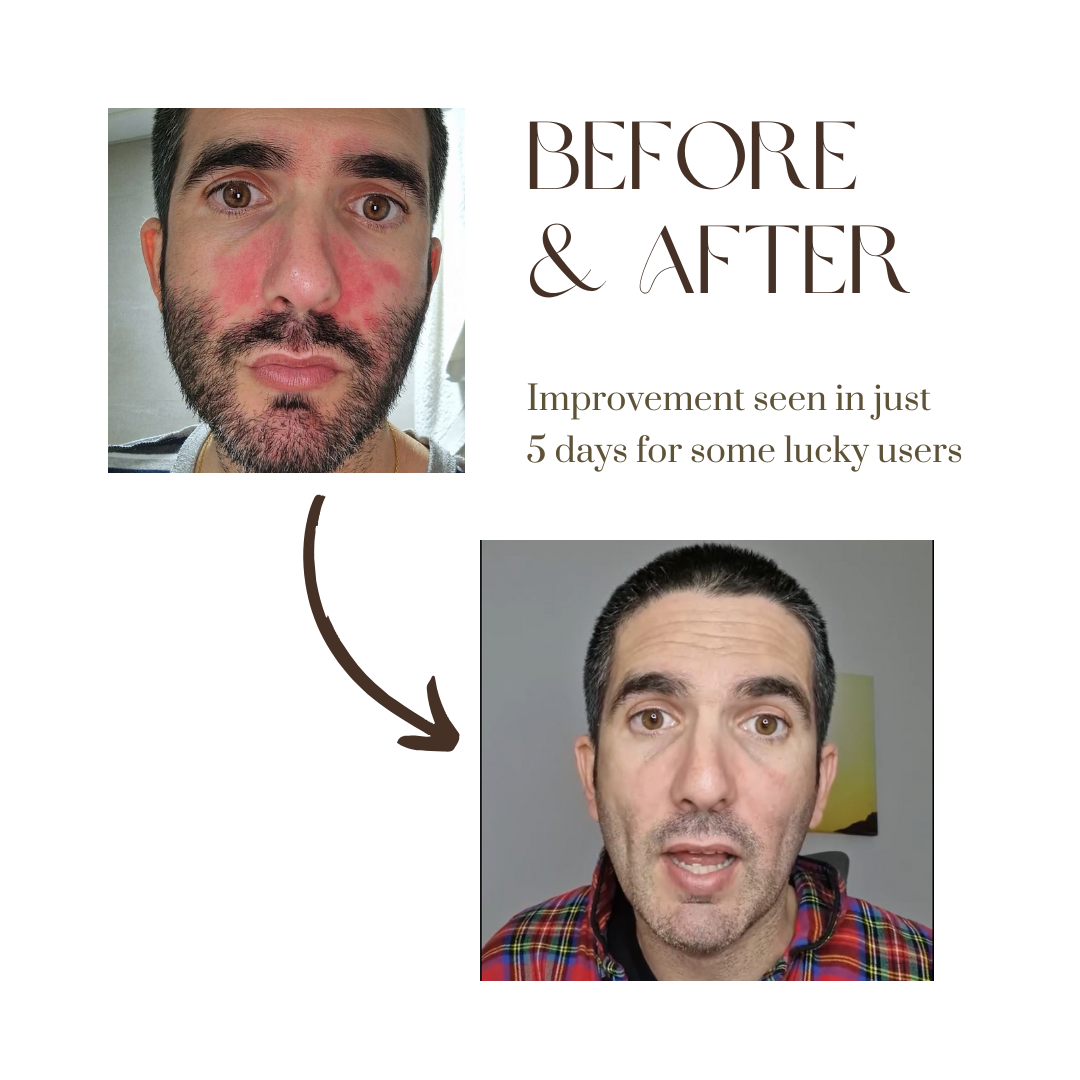 Abera Sebum Ecze Crema - Loción corporal completa para pieles con tendencia a la psoriasis, crema hidratante para eccemas, hidratante corporal, tubo de 1 oz. - Auténtico