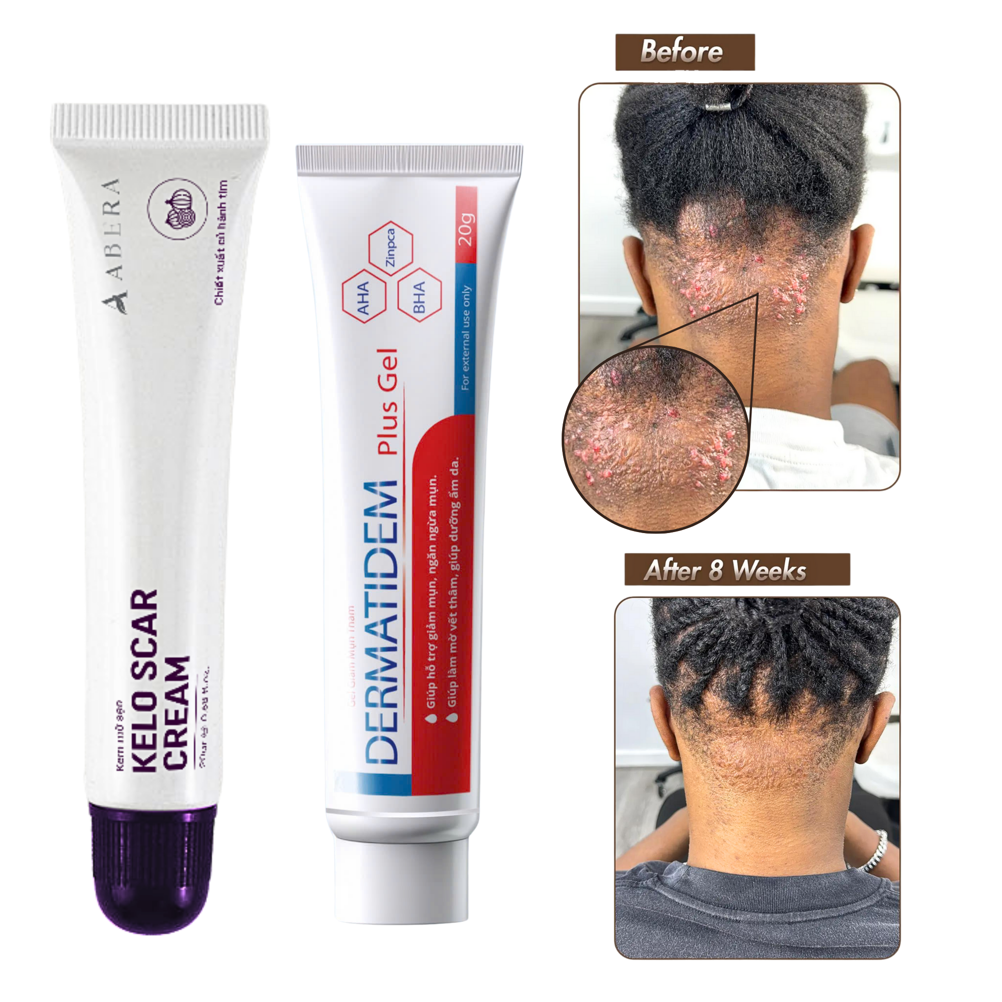 Abera Kelo Scar Cream - Big Discount 20%