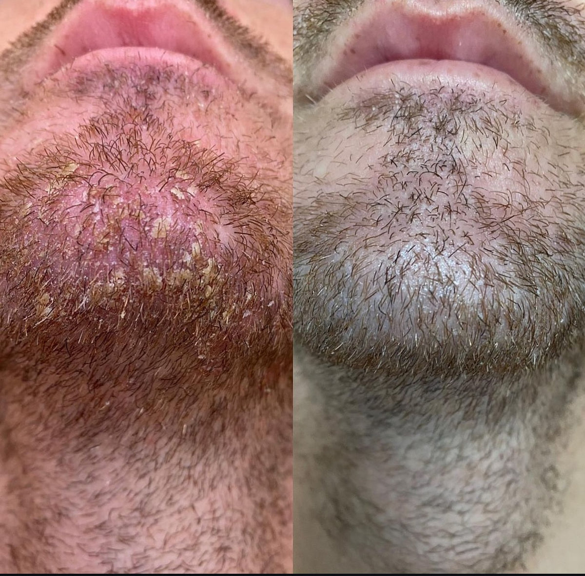 Comfort care for dry beard-area skin