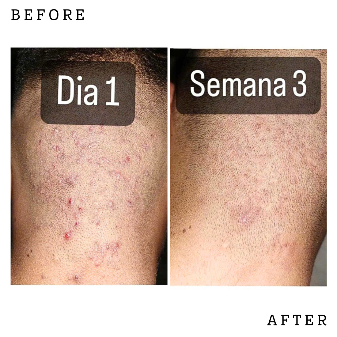 ABERA Amanda Champú Anti-Foliculitis y Dermatitis Seborreica 6.67 fl.oz - Auténtico