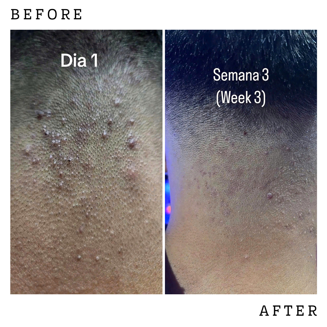 ABERA Amanda Champú Anti-Foliculitis y Dermatitis Seborreica 6.67 fl.oz - Auténtico