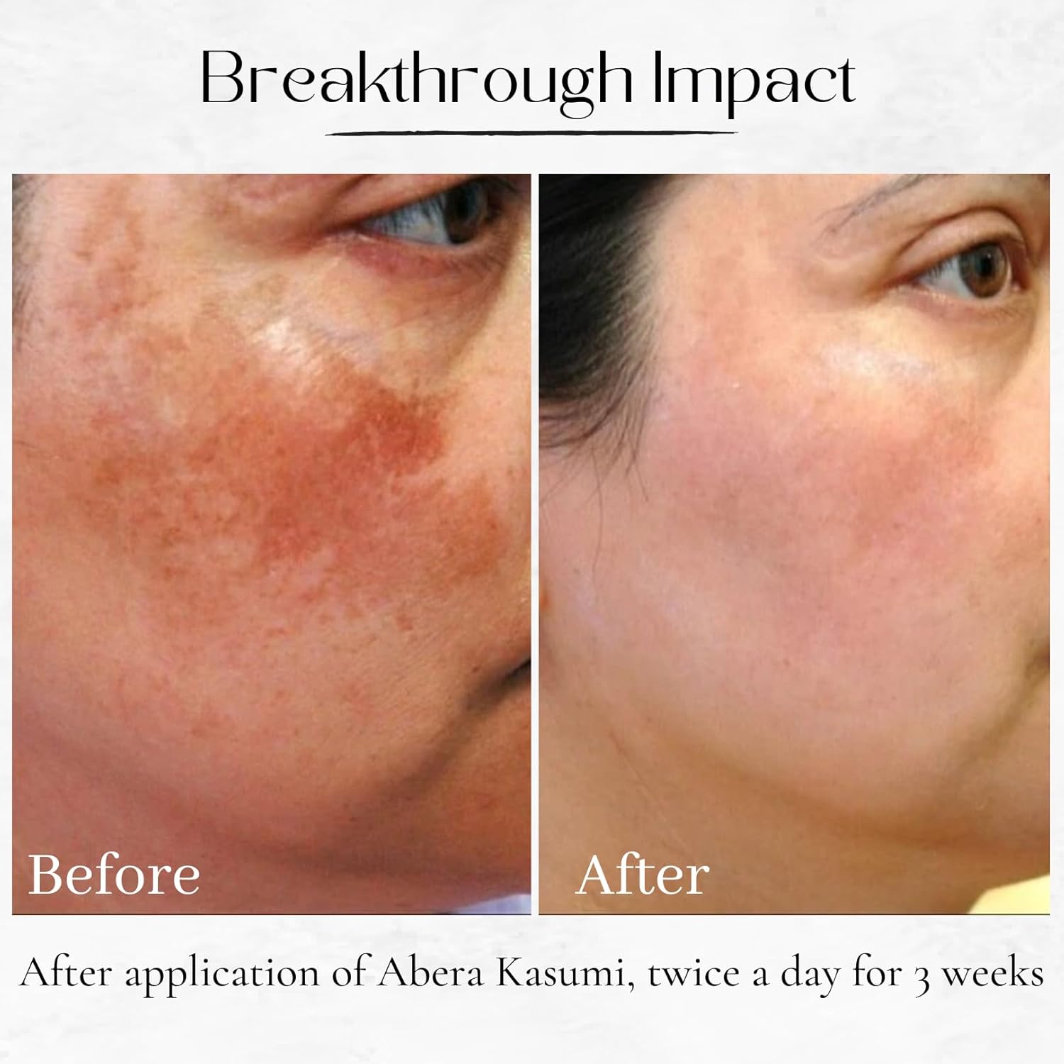 Intensive Melasma Care Duo – Targets Dark Spots, Freckles and Long-Term Discoloration