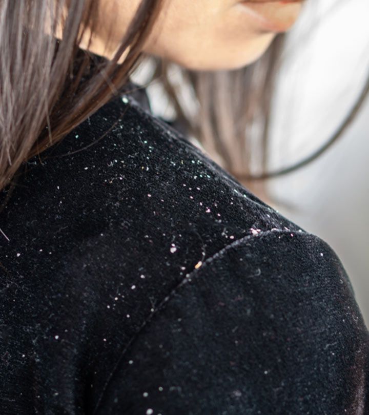 Visible flakes on a dark shirt