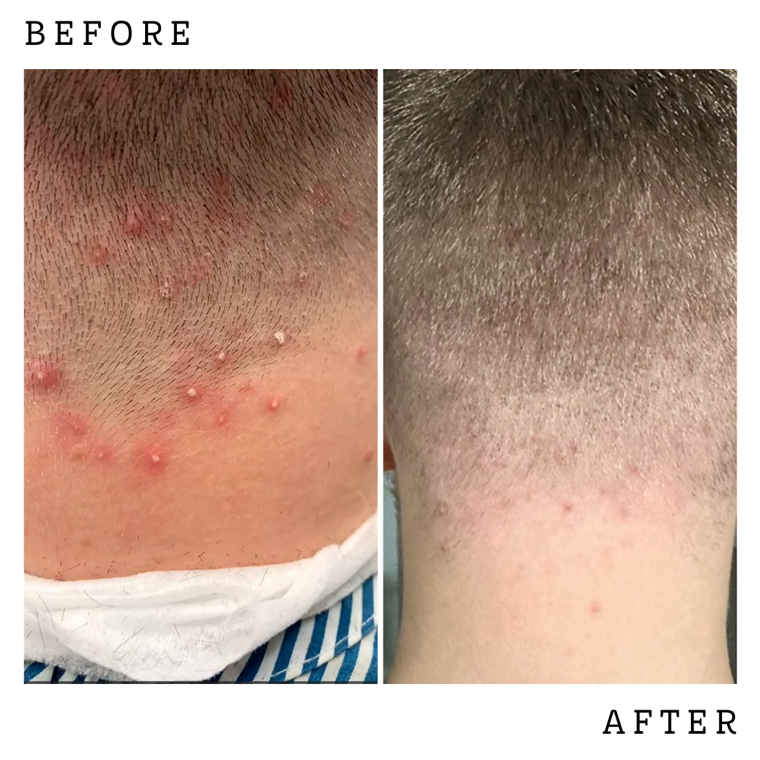 ABERA Amanda Champú Anti-Foliculitis y Dermatitis Seborreica 6.67 fl.oz - Auténtico
