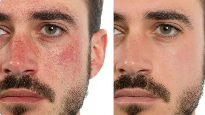 Hydration and skin barrier support