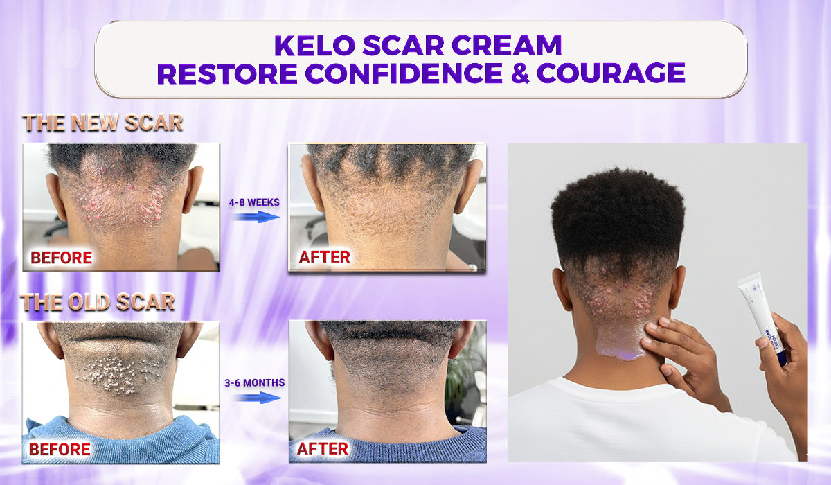 Abera Kelo Scar Cream