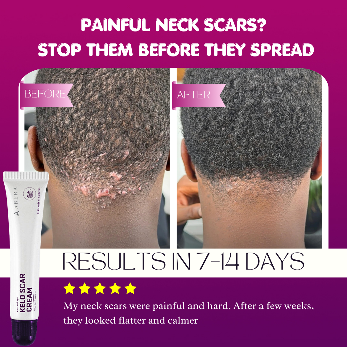 Abera Kelo Scar Cream – Clinical Formula for Raised Scars