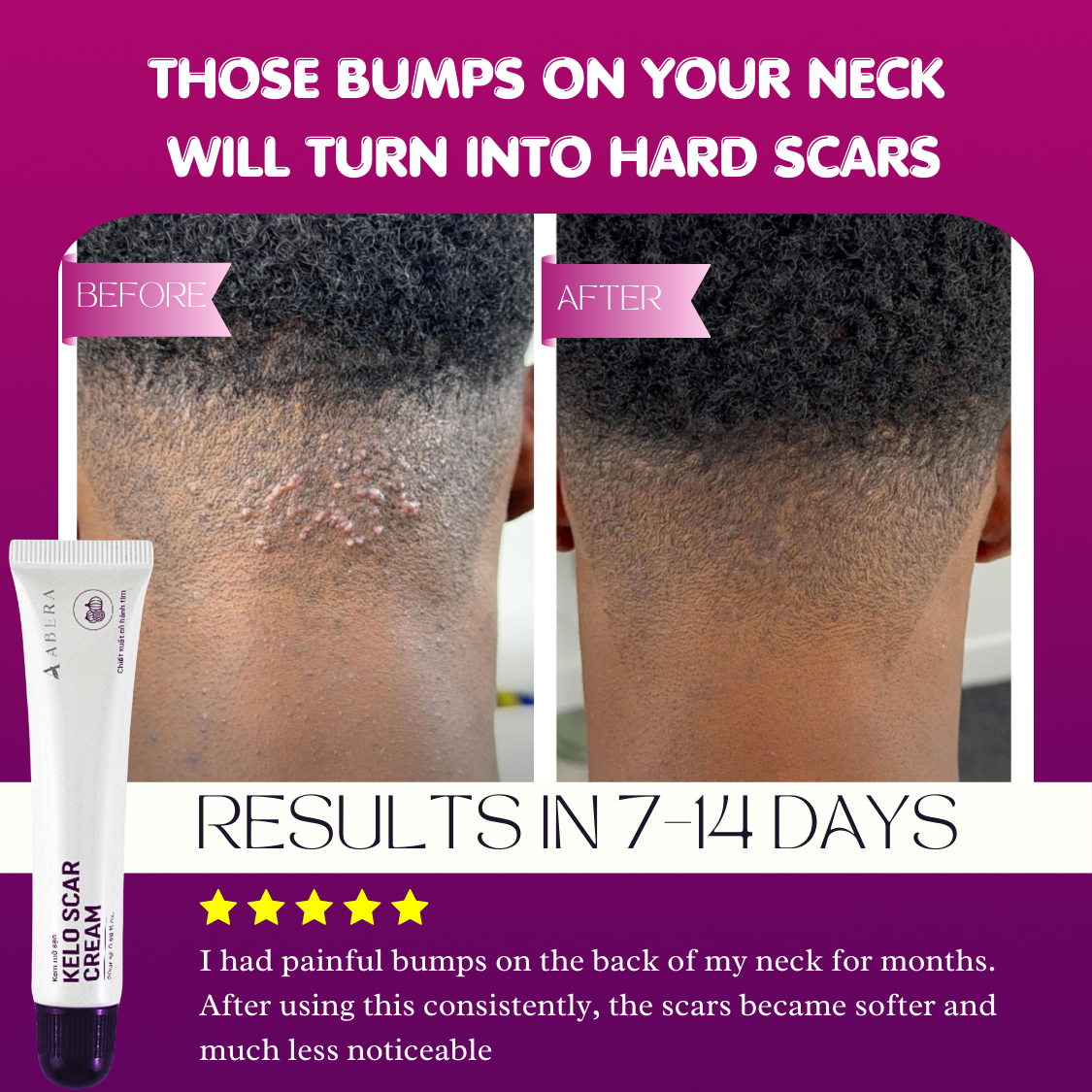 Abera Kelo Scar Cream – Clinical Formula for Raised Scars