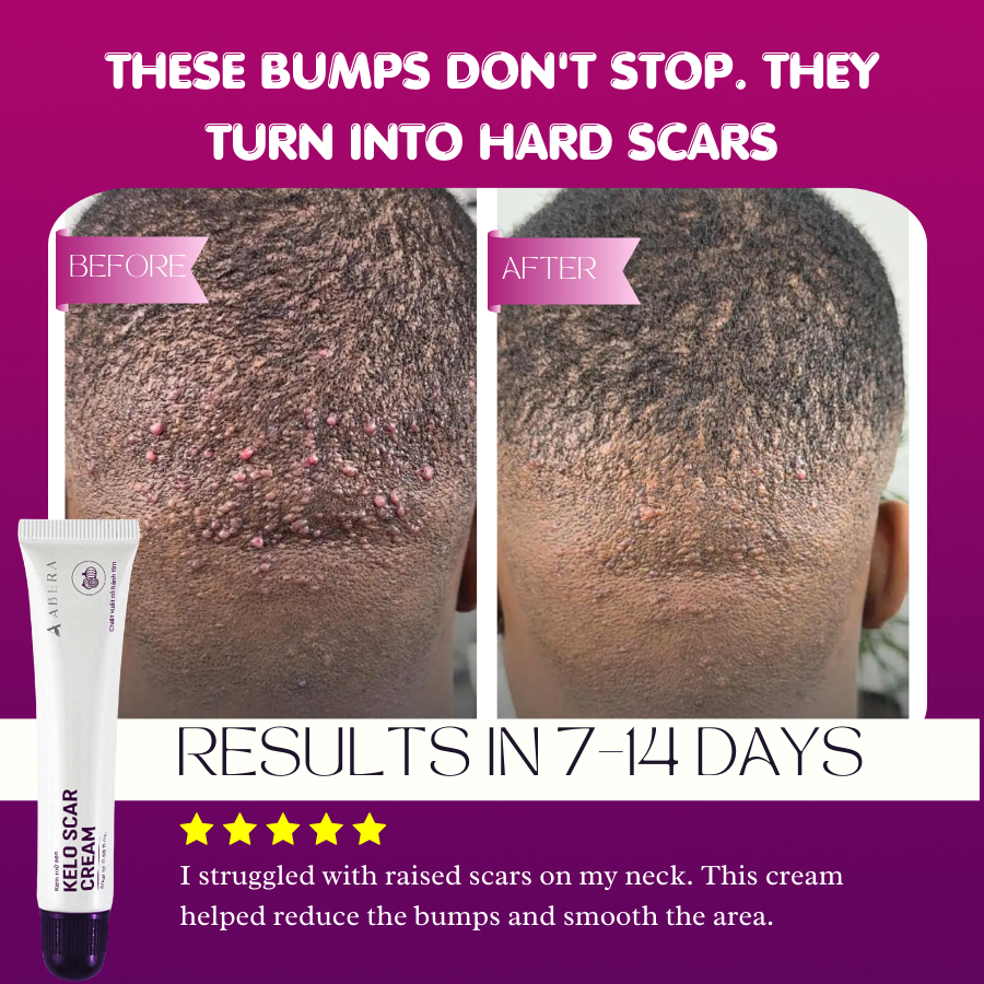 Abera Kelo Scar Cream – Clinical Formula for Raised Scars