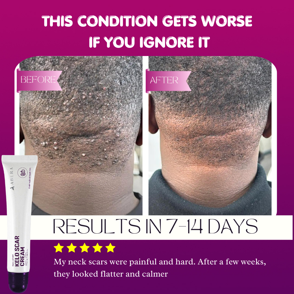 Abera Kelo Scar Cream – Clinical Formula for Raised Scars