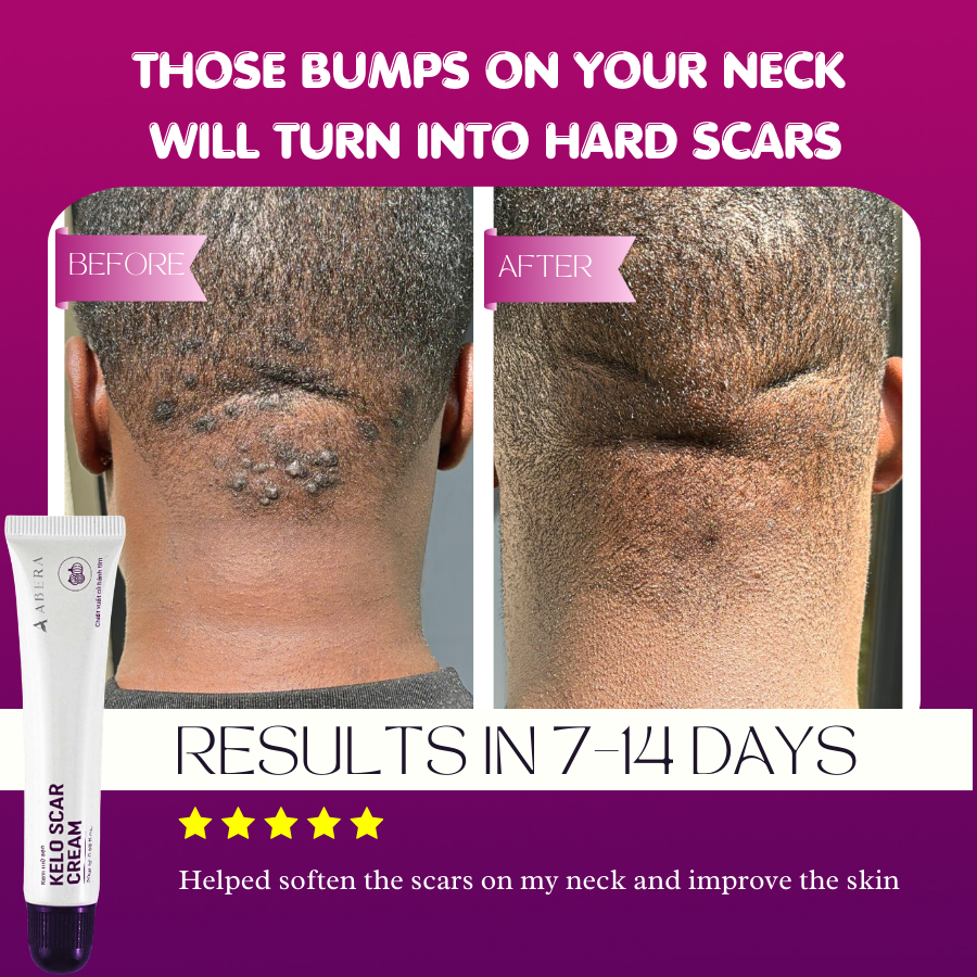 Abera Kelo Scar Cream – Clinical Formula for Raised Scars