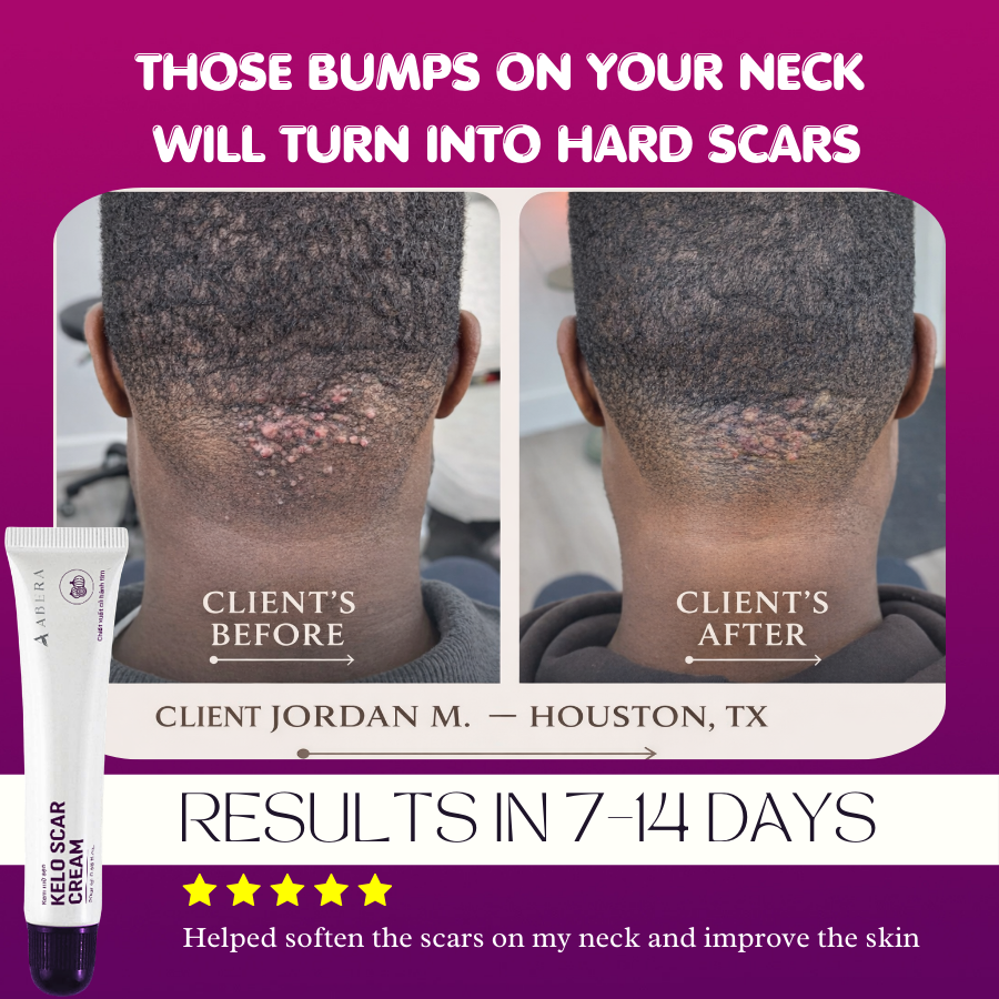 Abera Kelo Scar Cream – Clinical Formula for Raised Scars