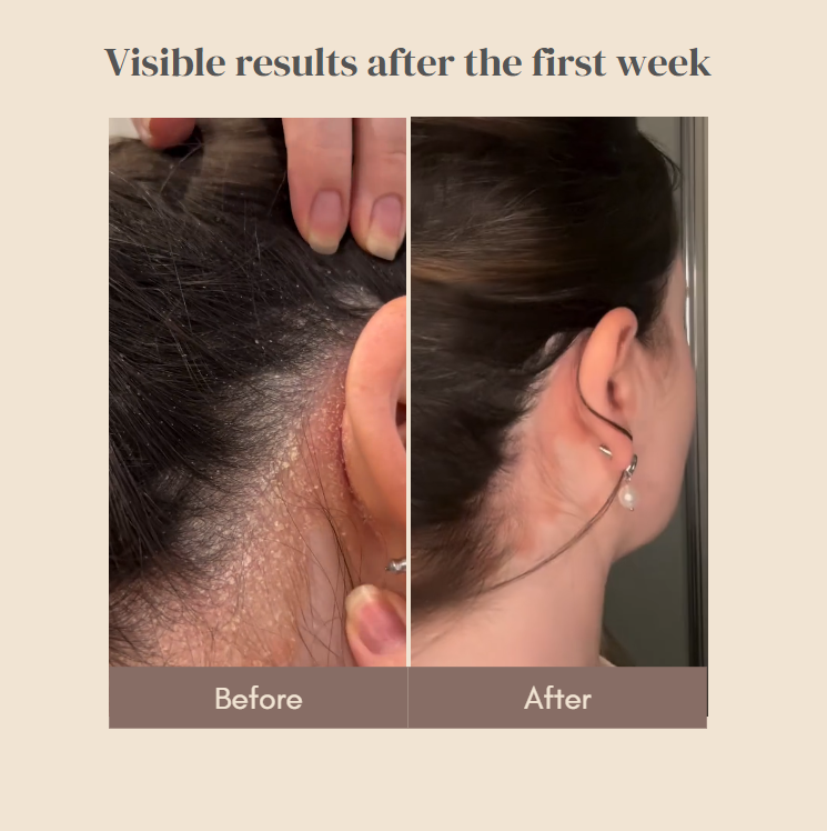 Abera Sebum Ecze Crema - Loción corporal completa para pieles con tendencia a la psoriasis, crema hidratante para eccemas, hidratante corporal, tubo de 1 oz. - Auténtico
