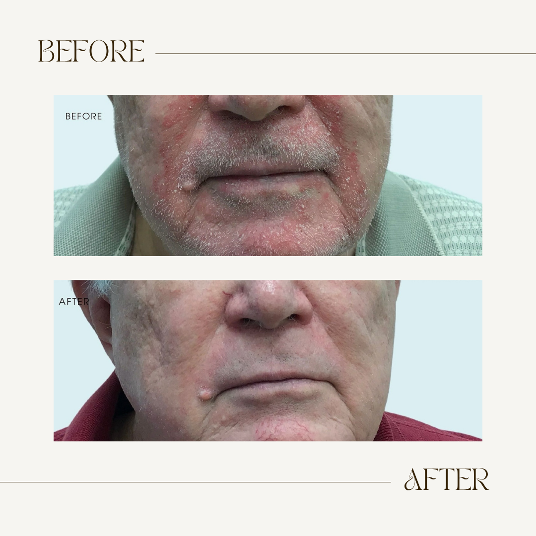 Abera Sebum Ecze Crema - Loción corporal completa para pieles con tendencia a la psoriasis, crema hidratante para eccemas, hidratante corporal, tubo de 1 oz. - Auténtico