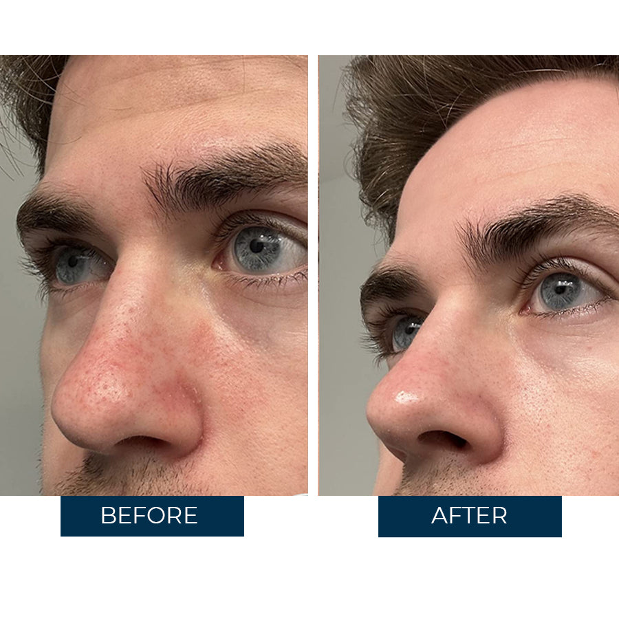 Abera Sebum - Fórmula avanzada para la dermatitis atópica y la psoriasis,...