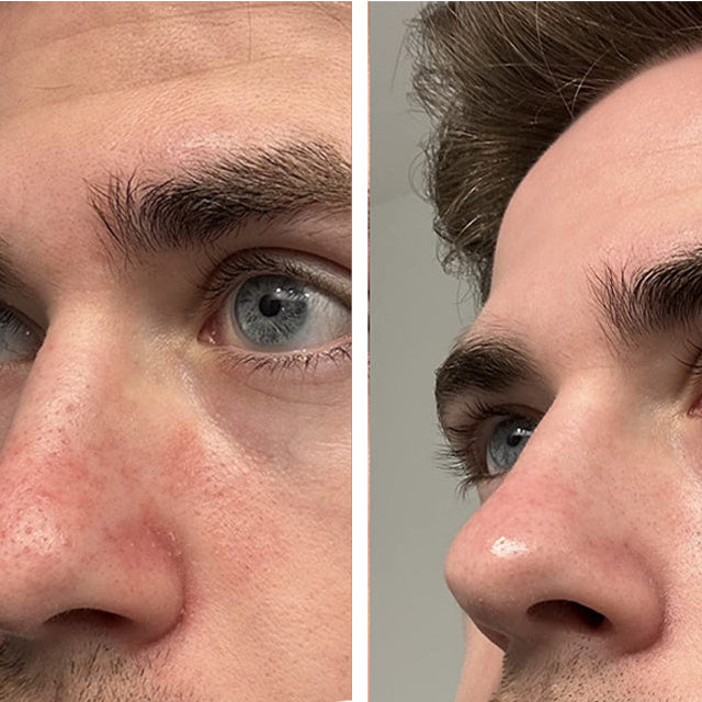 Dry-looking skin around the nose and eyebrows