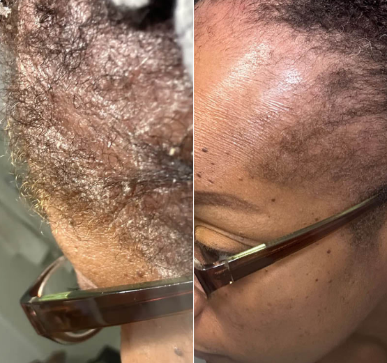 Crema Abera Fordyce - La solución #1 recomendada por dermatólogos para las manchas de Fordyce en los labios