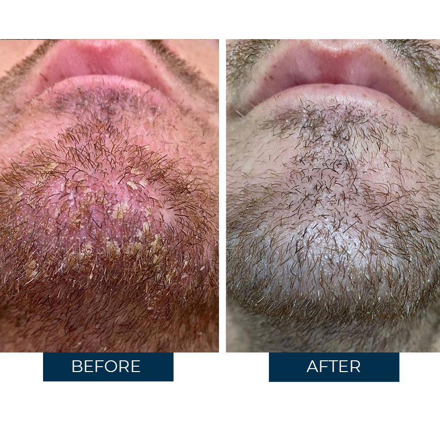 Abera Sebum - Fórmula avanzada para la dermatitis atópica y la psoriasis,...