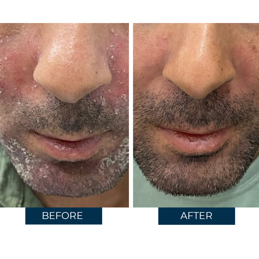 Abera Sebum - Fórmula avanzada para la dermatitis atópica y la psoriasis,...