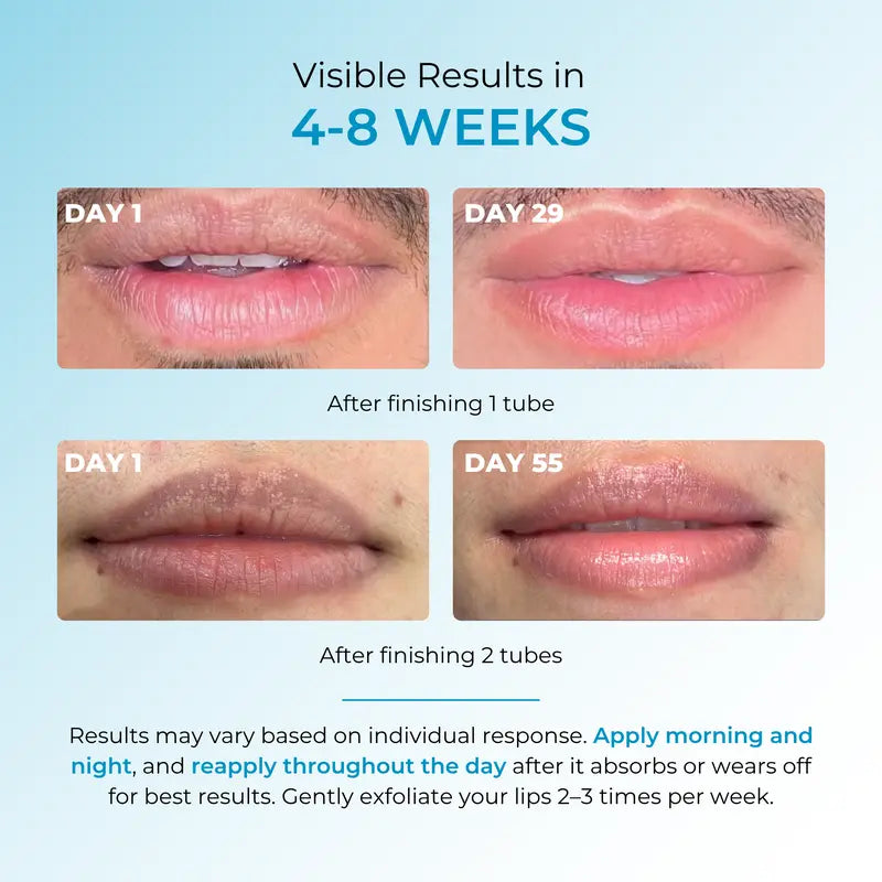 Fordyce Cream for Lips