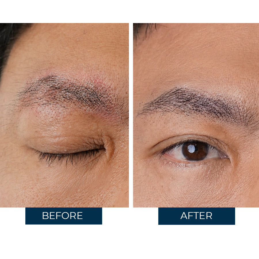 Abera Sebum - Fórmula avanzada para la dermatitis atópica y la psoriasis,...