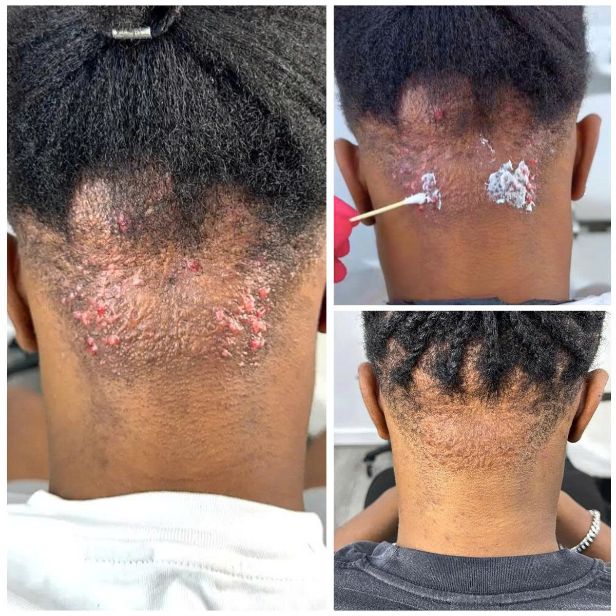 Abera Kelo Scar Cream – For Raised Scars